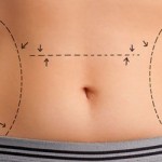 Karın germe ile dümdüz karınlar