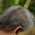 Profesyonel Saç Ekimi Aşamaları